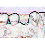 Prothese, Br&uuml;cke, Implantat?