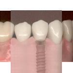 Festgewachsenes Implantat mit neuer Zahnkrone